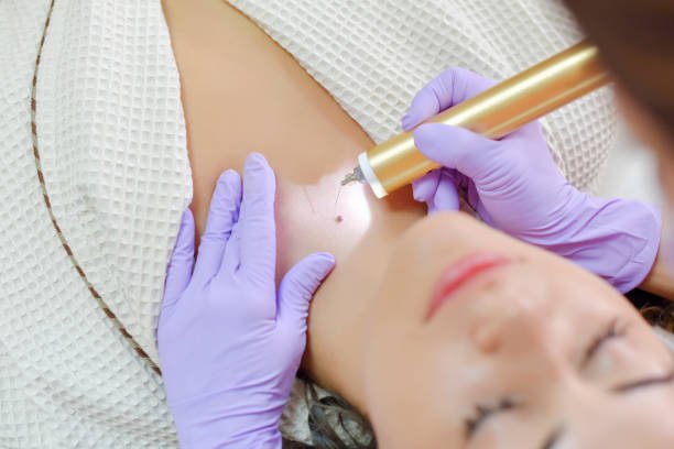 How to Remove Skin Tags in One Night at Home